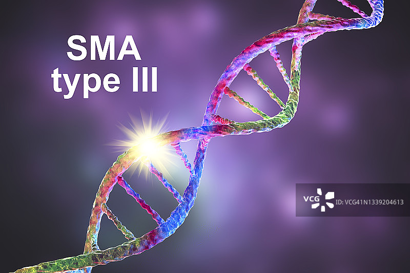 脊髓性肌萎缩症插图图片素材