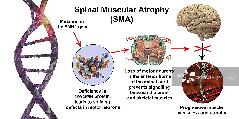 脊髓性肌萎缩症插图图片素材
