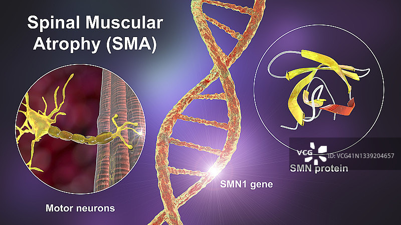脊髓性肌萎缩症插图图片素材
