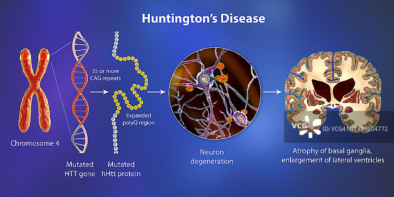 亨廷顿舞蹈症的分子基因，3D图解图片素材