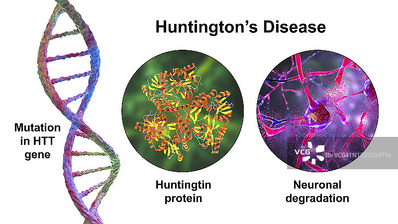 亨廷顿舞蹈症概念图图片素材