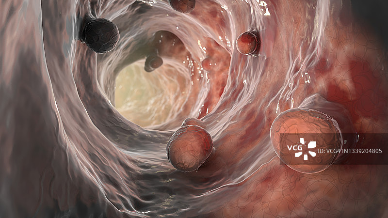 结直肠息肉，图示图片素材