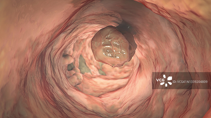 结直肠息肉，图示图片素材