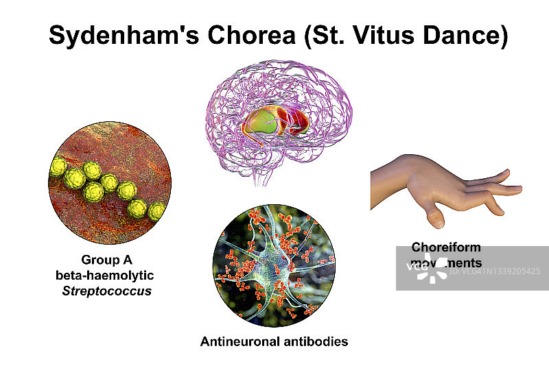 西德纳姆舞蹈症插图图片素材