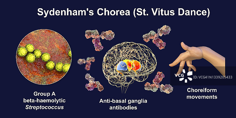 西德纳姆舞蹈症插图图片素材