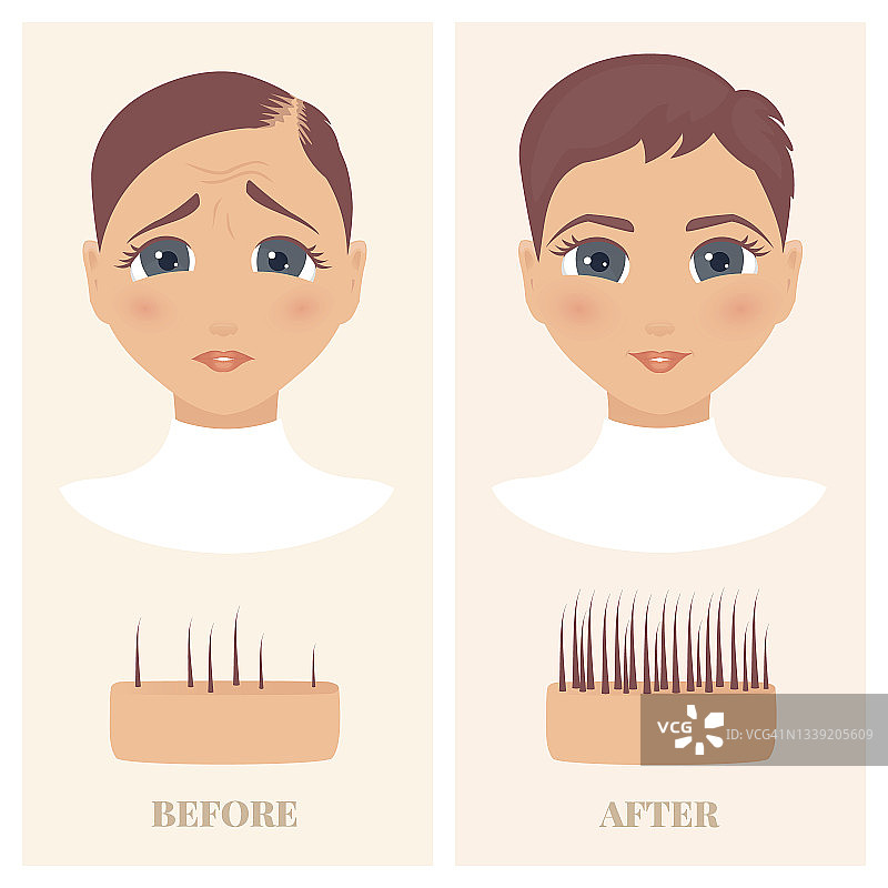 女性脱发治疗插画图片素材