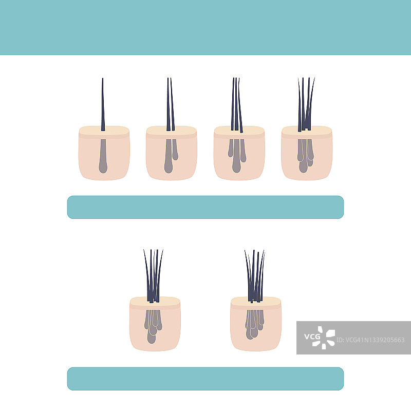 毛发微移植分类概念图图片素材