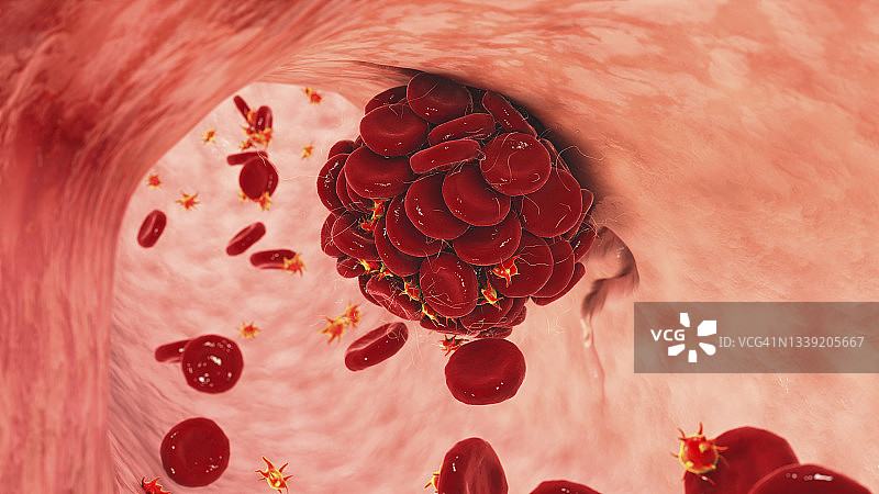 血凝块、插图图片素材