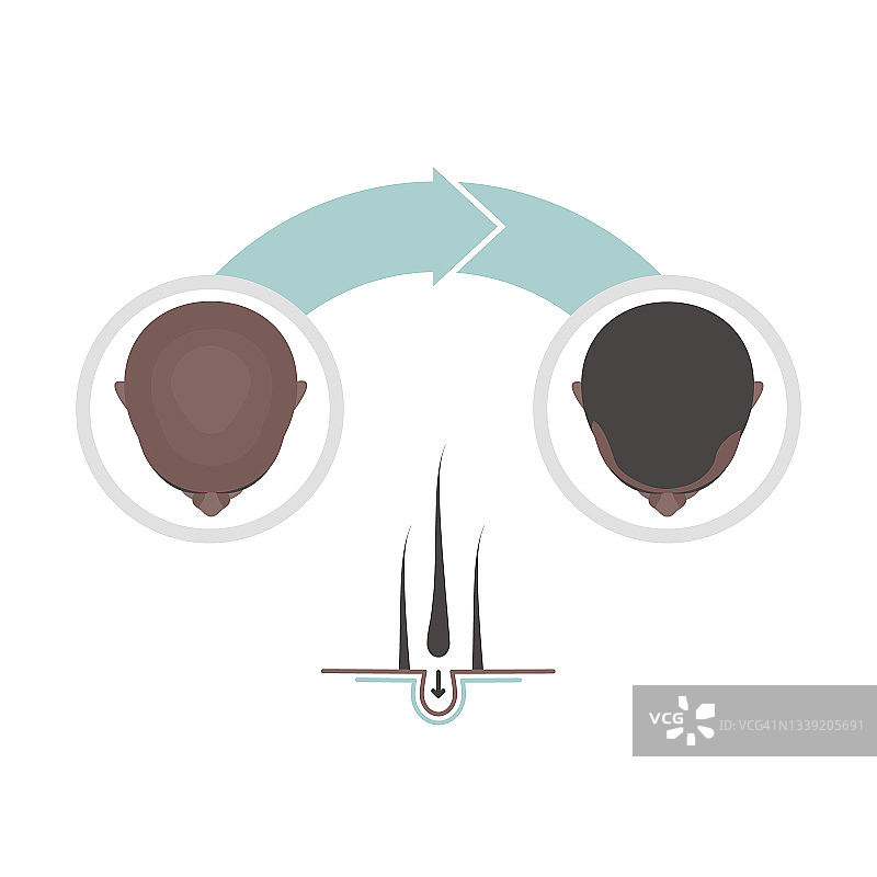 男性植发概念插图图片素材