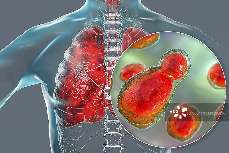 肺隐球菌病插图图片素材