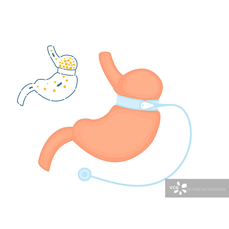 可调节胃束带减肥手术图图片素材