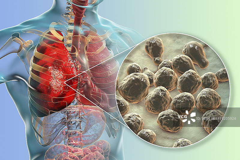 肺隐球菌病插图图片素材