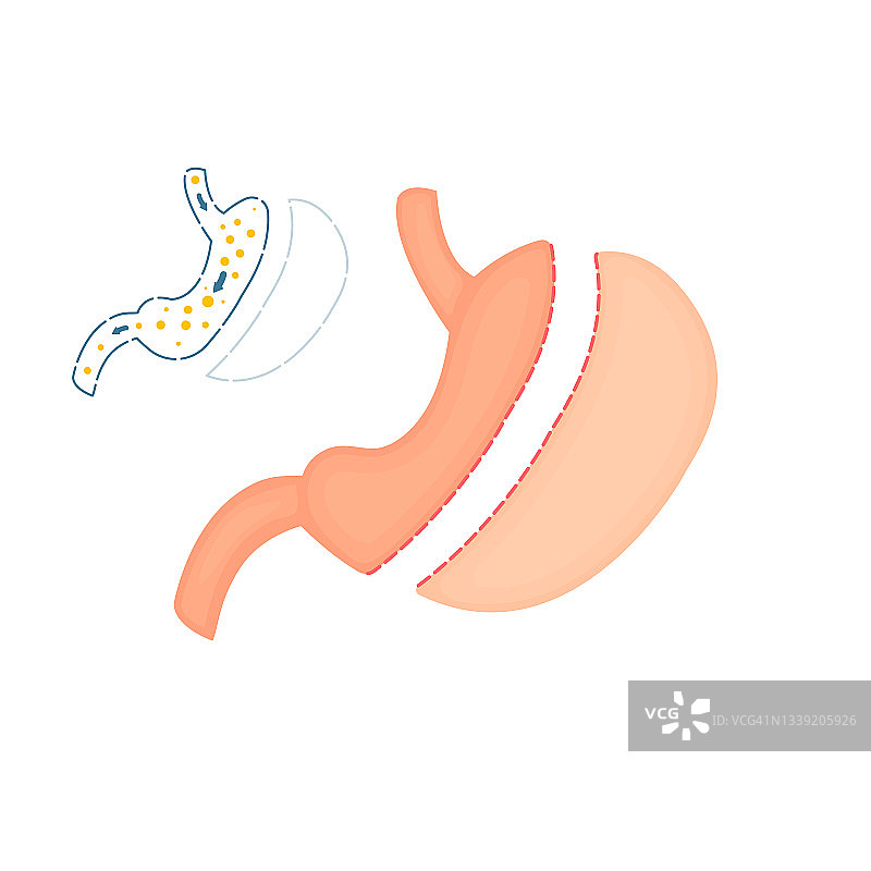 袖状胃切除减肥手术插图图片素材