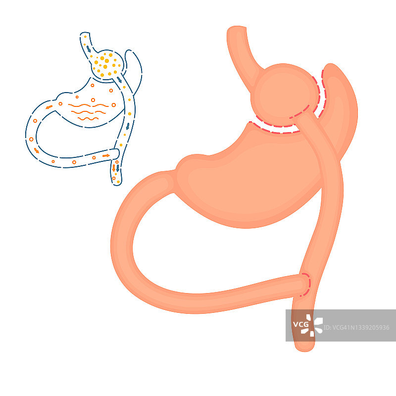 胃旁路减肥手术示意图图片素材