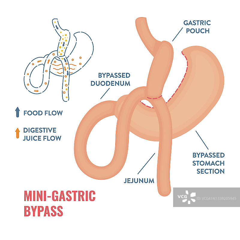 迷你胃旁路减肥手术图示图片素材