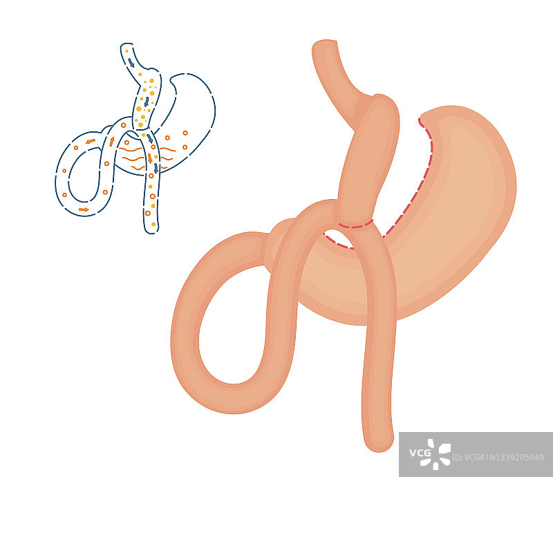 迷你胃旁路减肥手术图示图片素材