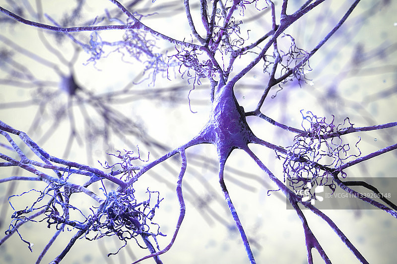 受阿尔茨海默病影响的神经细胞插图图片素材