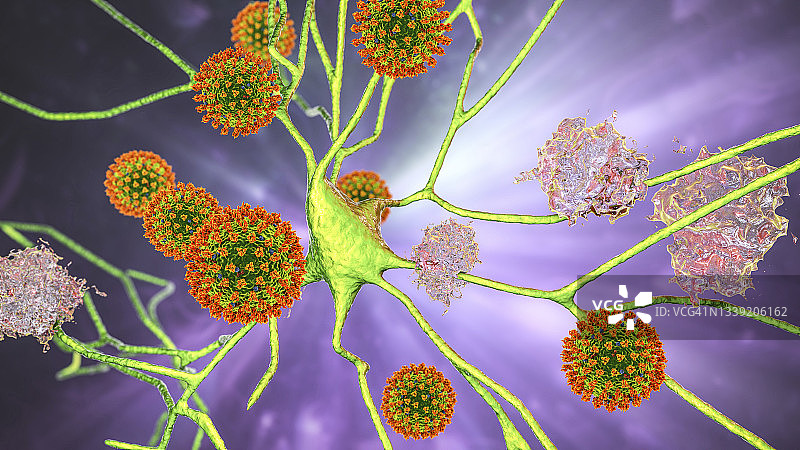 痴呆症的传染性病因概念图图片素材