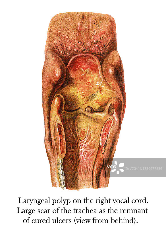 古老的雕刻插图：喉咙疾病，右声带上的喉息肉（从后方看），气管的大疤痕是治愈溃疡的残余图片素材