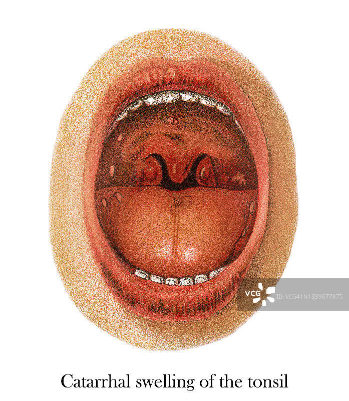 喉咙疾病古老雕刻插图：扁桃体卡他性肿胀图片素材
