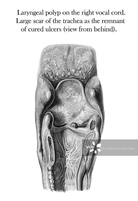 古老的雕刻插图：喉咙疾病，右声带上的喉息肉（从后方看），气管的大疤痕是治愈溃疡的残余图片素材