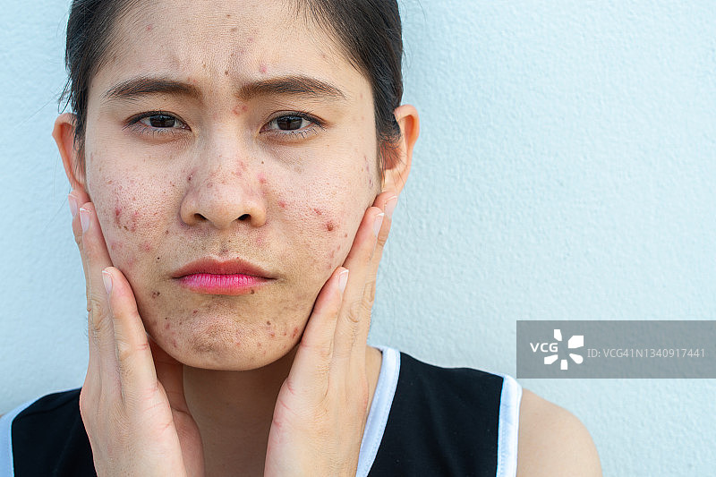 面部痤疮发炎的亚洲女性肖像图片素材