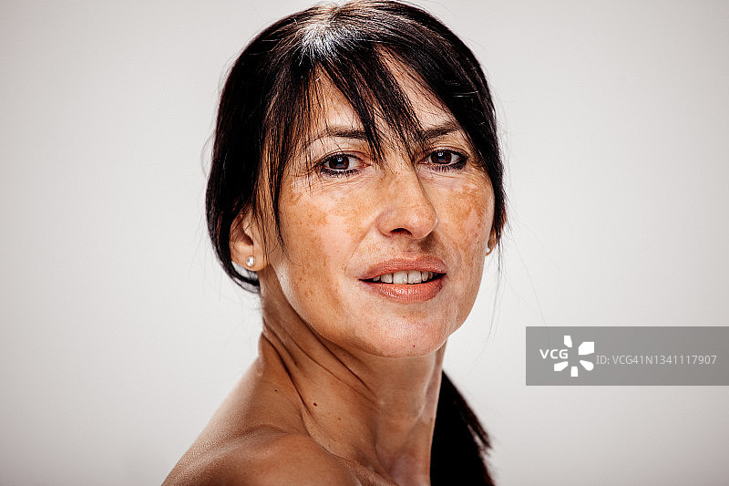 美丽的白种人妇女皮肤问题白癜风图片素材