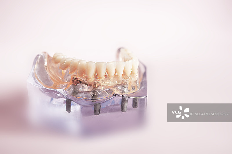 牙科植入体透明模型图片素材