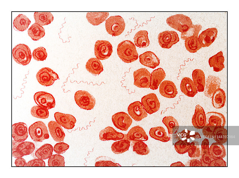 显微镜下血液中螺旋体的古老雕刻插图（750：1）图片素材