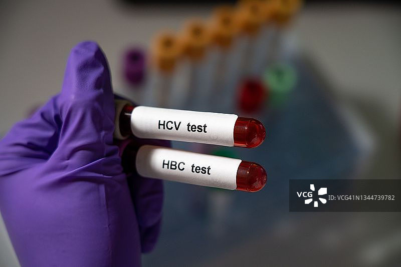 乙肝和丙肝图片素材