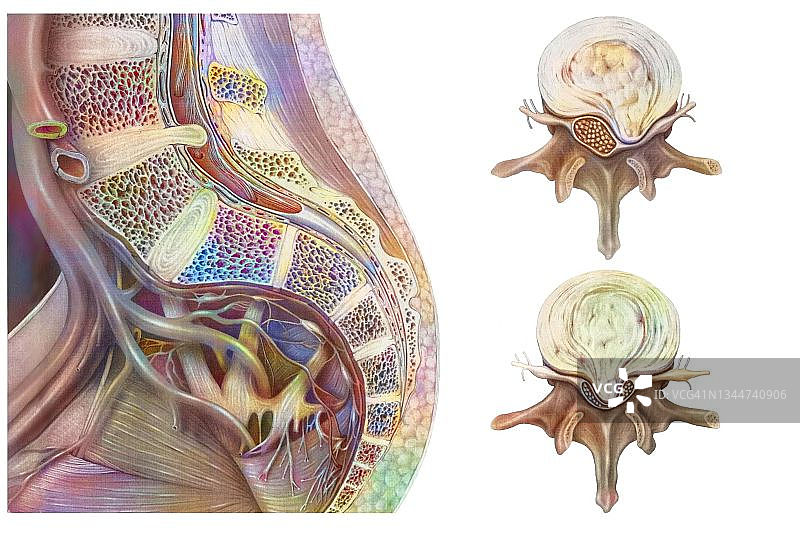 椎间盘突出示意图图片素材
