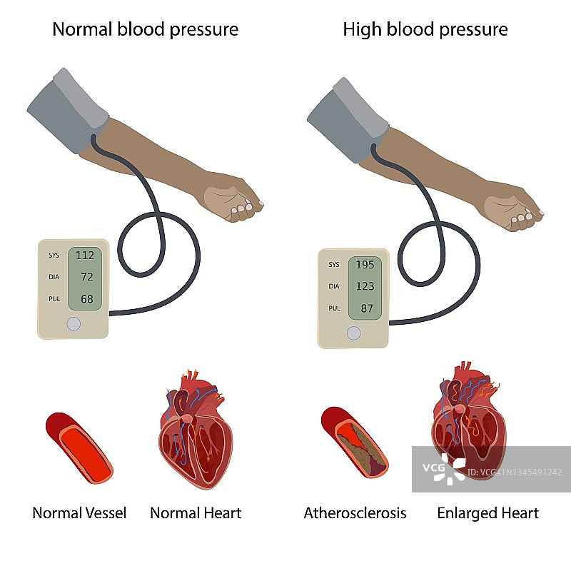 高血压性心脏病插图图片素材