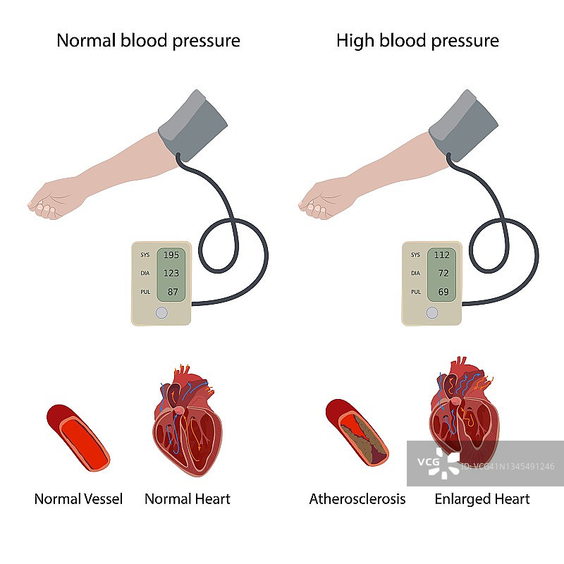 高血压性心脏病插图图片素材