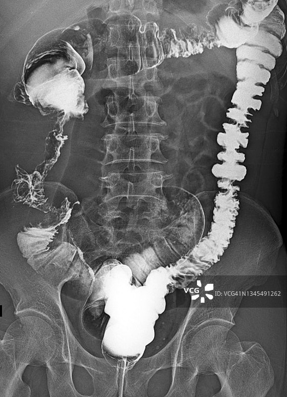 结直肠癌X光片图片素材
