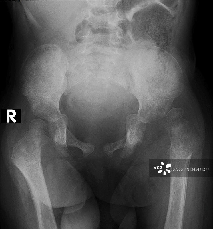髋关节发育不良X光片图片素材