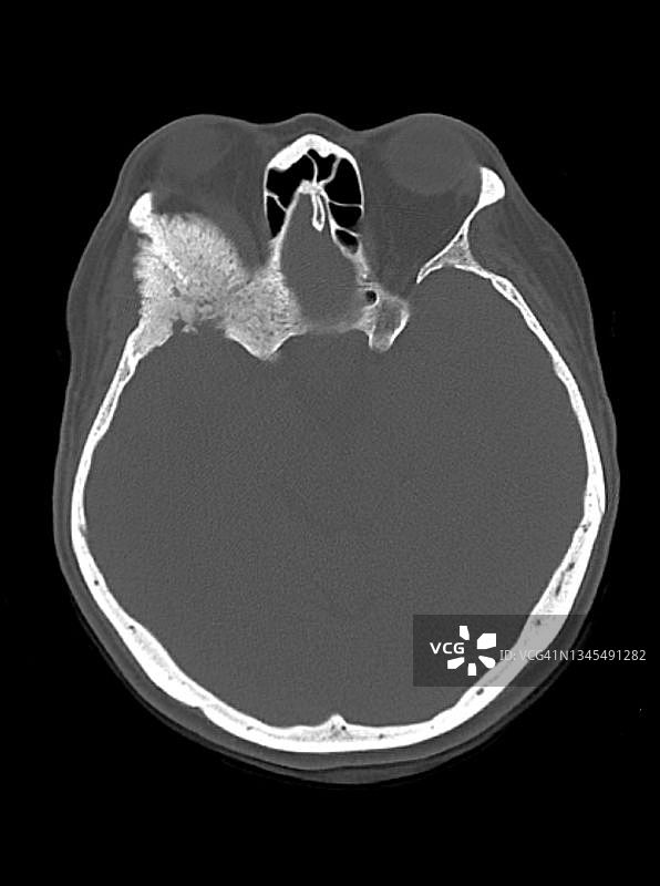 骨内脑膜瘤CT扫描图片素材