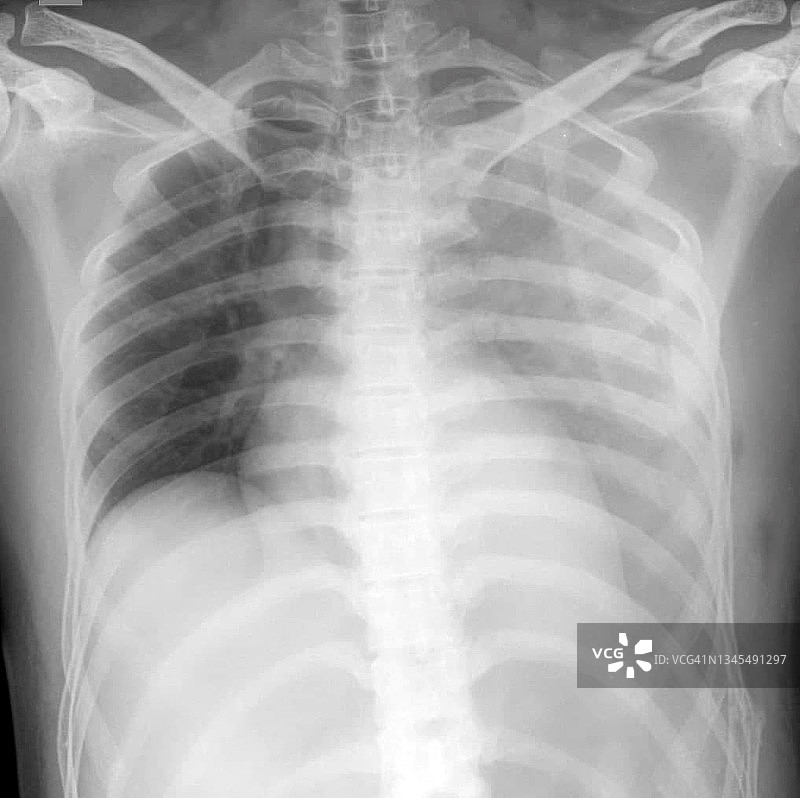 血胸和多发性骨折X光片图片素材