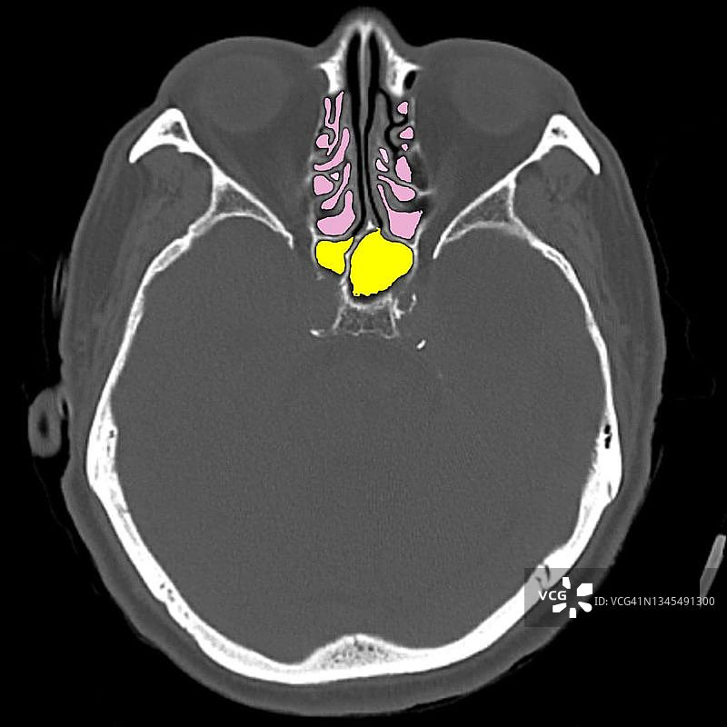 鼻窦解剖，CT扫描图片素材
