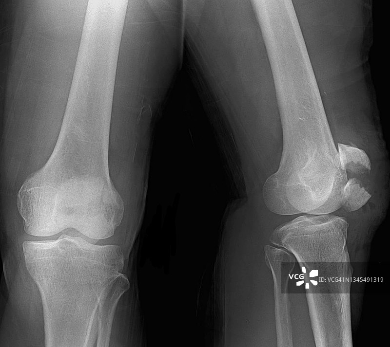 膝盖骨折X光片图片素材