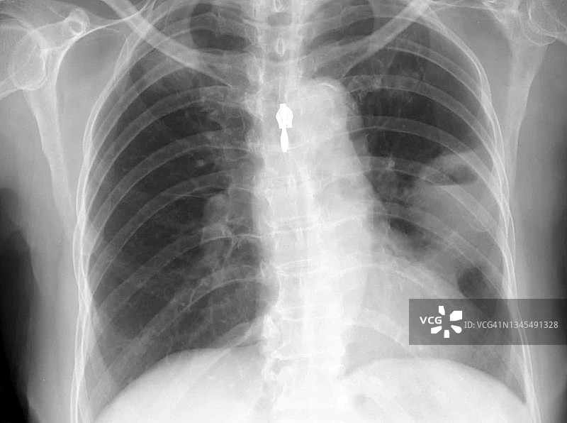 肺脓肿X光片图片素材