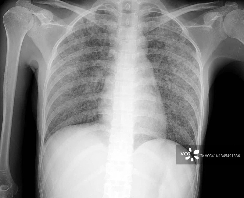 粟粒性结核病，X光片图片素材