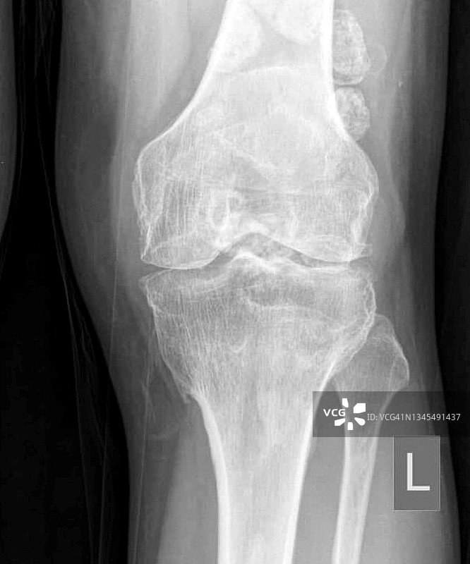 滑膜软骨瘤病X光片图片素材