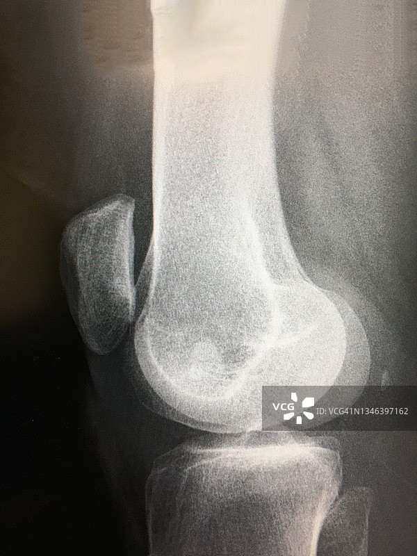 膝盖X光片图片素材