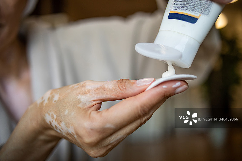 居家呵护美丽的女人：白癜风护理图片素材