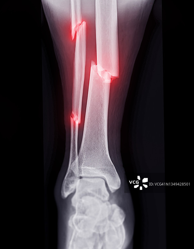 踝关节X光影像：胫骨和腓骨骨折图片素材