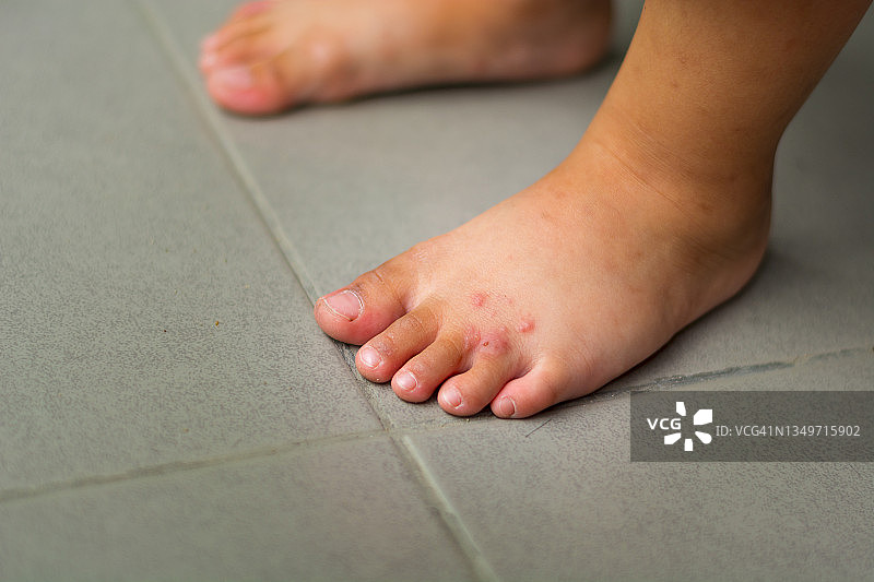 年轻女子脚部发痒，伴有红肿皮疹。瘙痒的可能原因包括足癣（真菌感染）、皮炎（湿疹）、牛皮癣或虫咬。健康护理。留白。图片素材