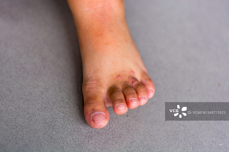年轻女子脚部发痒，伴有红肿皮疹。瘙痒的可能原因包括足癣（真菌感染）、皮炎（湿疹）、牛皮癣或虫咬。健康护理。留白。图片素材