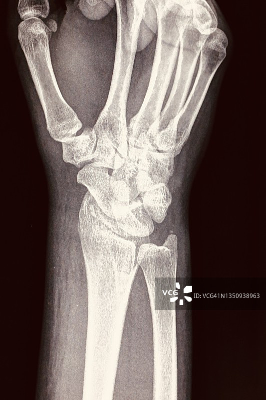 手臂、手腕和手部X光片，黑色背景图片素材