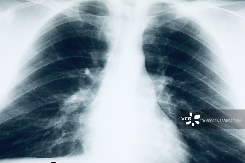 肺部X光中的肺炎图片素材
