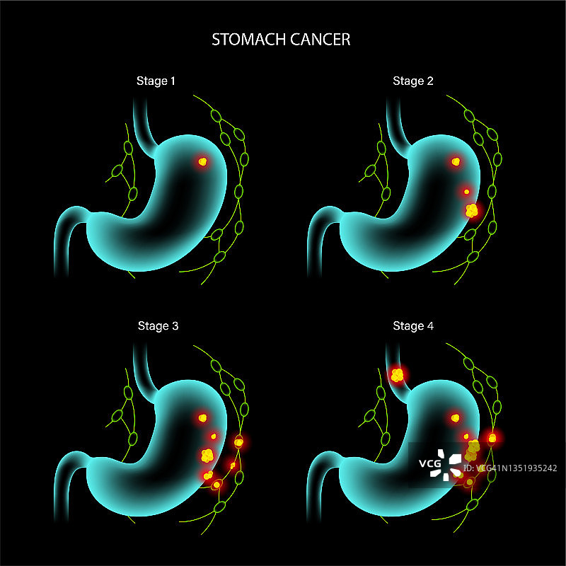 胃癌解剖图片素材